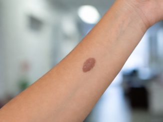 Cifras preliminares: 22 personas habrían fallecido por cáncer de piel en la Región de Antofagasta en 2025